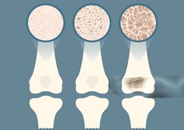 Bone Health & Osteoporosis
